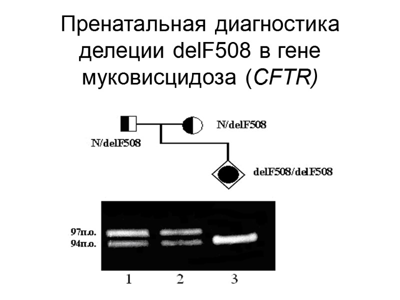 Пренатальная диагностика делеции delF508 в гене муковисцидоза (CFTR)